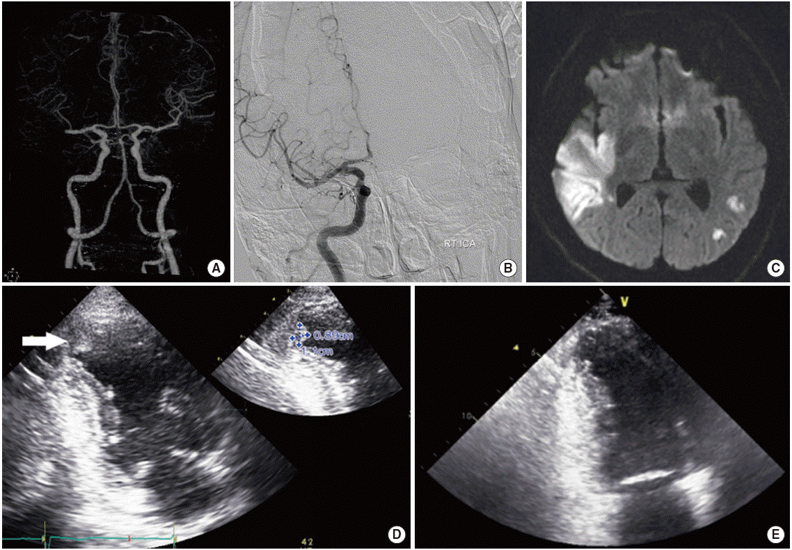 Dabigatran Effect on Left Ventricular Thrombus in a Patient with Acute Ischemic Stroke